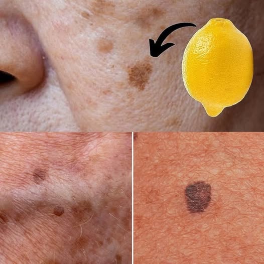 Fade Age Spots Naturally with Lemon Here's How!