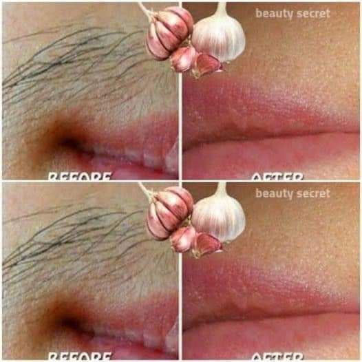 Natural Hair Removal with Garlic Say Goodbye to Unwanted Hair