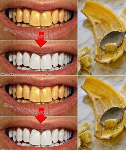 Quick Teeth Whitening with Banana Peels Achieve Shiny White Teeth in Just 2 Minutes!